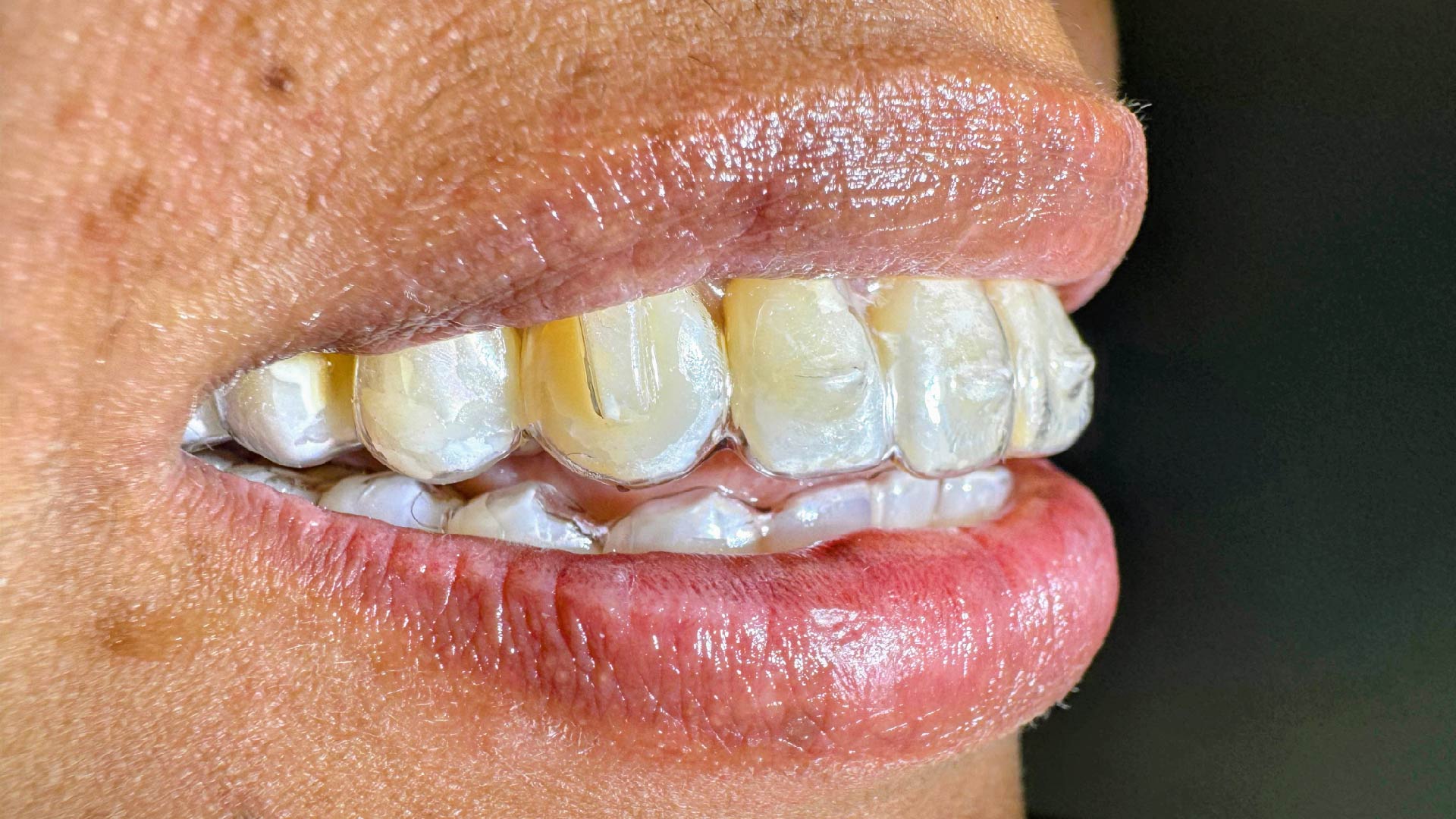 Alineadores invisbles invisible alligners ortodoncia orthodontics