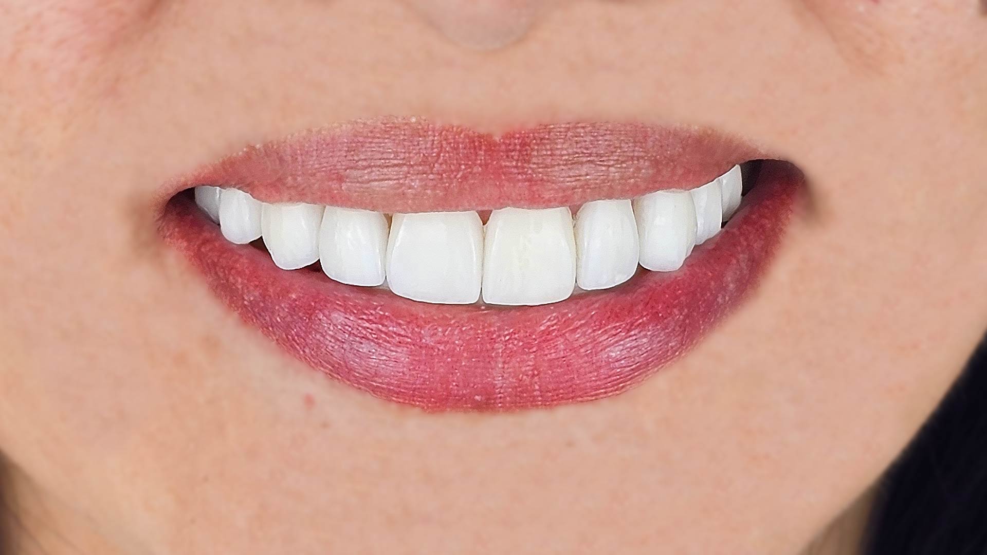Smile design porcelain veneers diseño de sonrisa carillas porcelana
