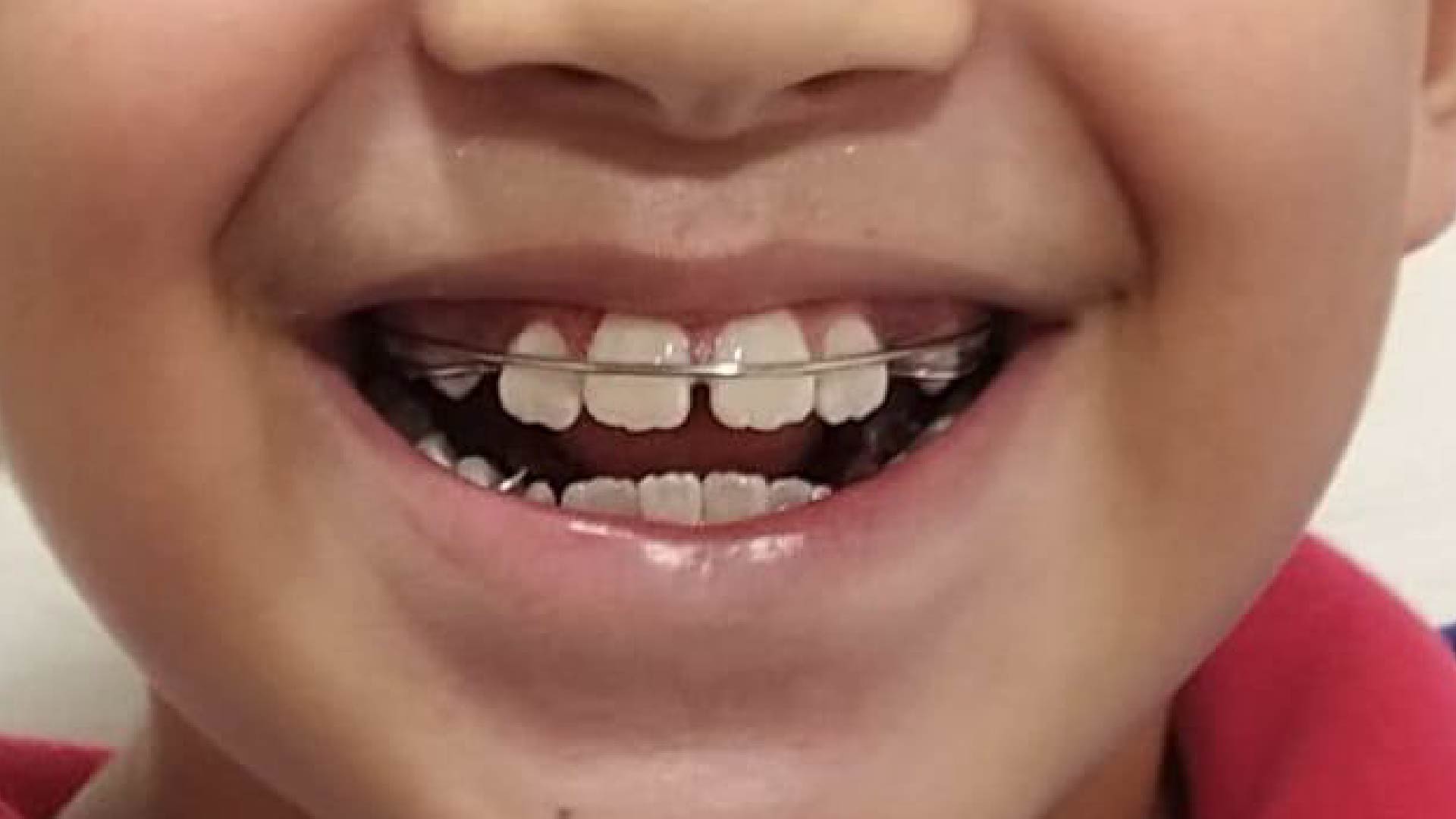 ortopedia maxilar aparatos orthopedics